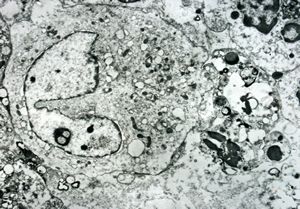 eosinophilic granuloma - Langerhans cell eosinophilic granuloma - Langerhans cell